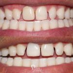 closeup-before-after-non-restorable-tooth-replaced-dental-implant-featured