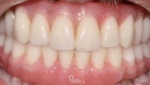 closeup-before-after-upper-and-lower-implant-retained-dentures-featured