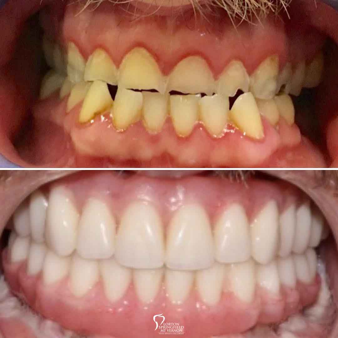 closeup-before-after-upper-and-lower-implant-retained-dentures