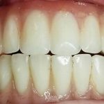 closeup-before-after-upper-hybrid-conversion-dental-implants-featured