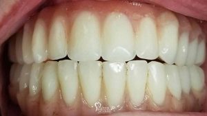 closeup-before-after-upper-hybrid-conversion-dental-implants-featured
