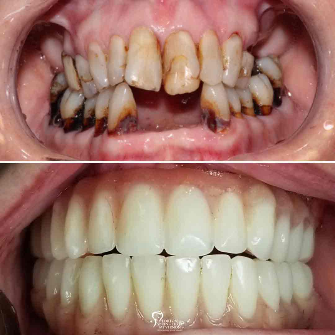 closeup-before-after-upper-hybrid-conversion-dental-implants