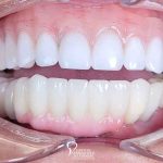 dental-implant-supported-hybrid-denture-feature2