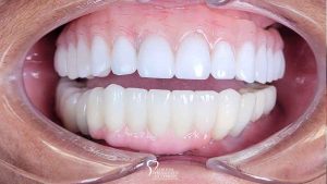 dental-implant-supported-hybrid-denture-feature2