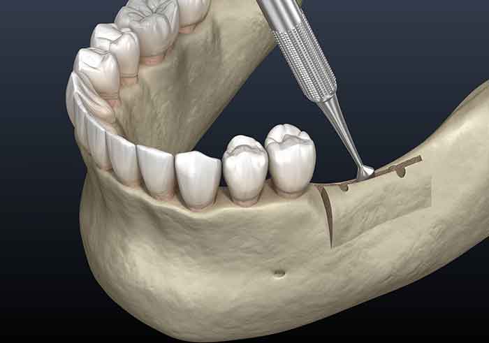 dental-ridge-augmentation