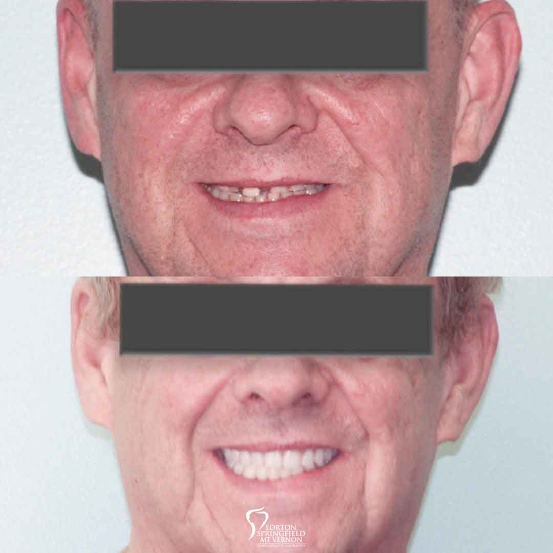 full-face-before-after-hybrid-denture-smile-makeover