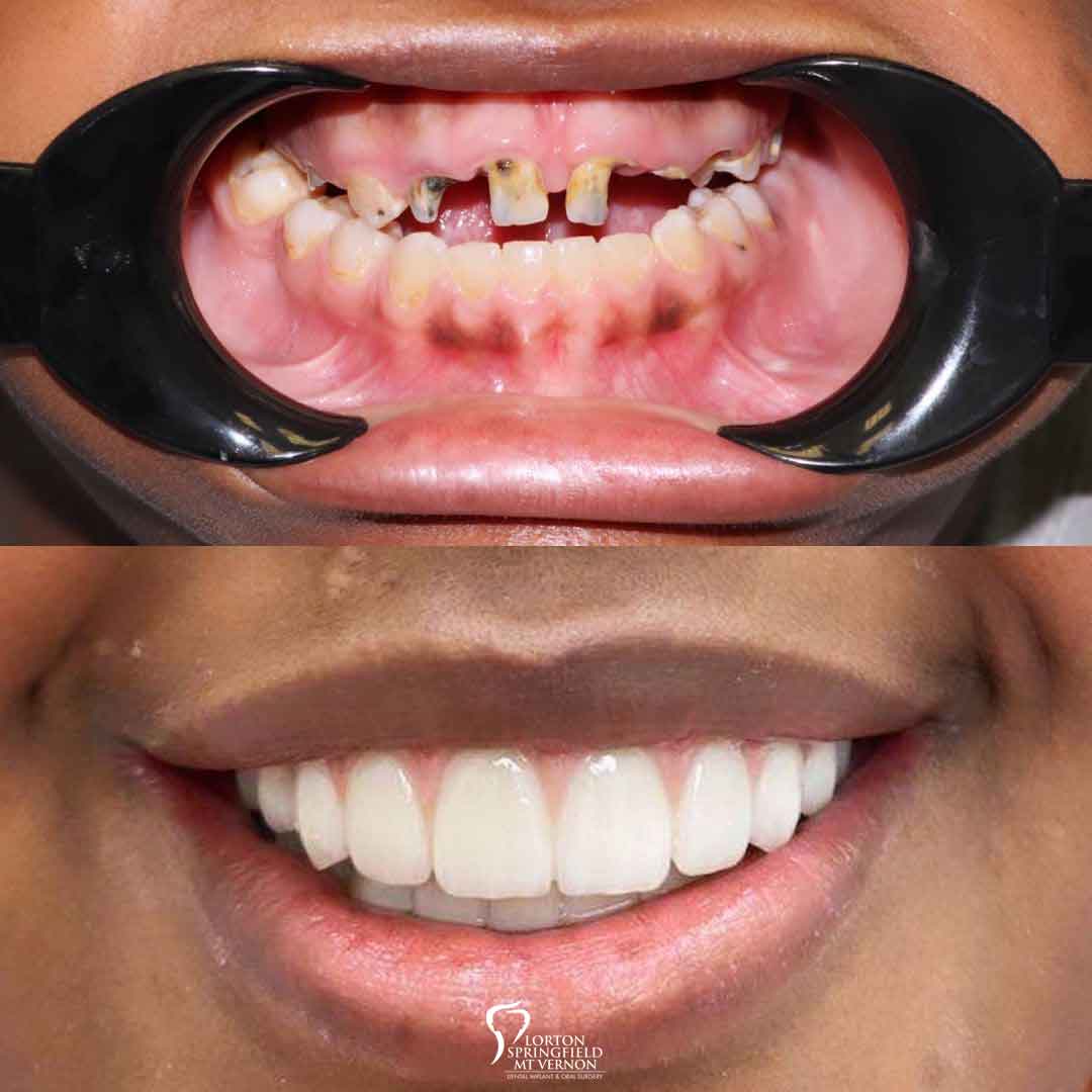 full-smile-makeover-dental-implants-before-after-closeup