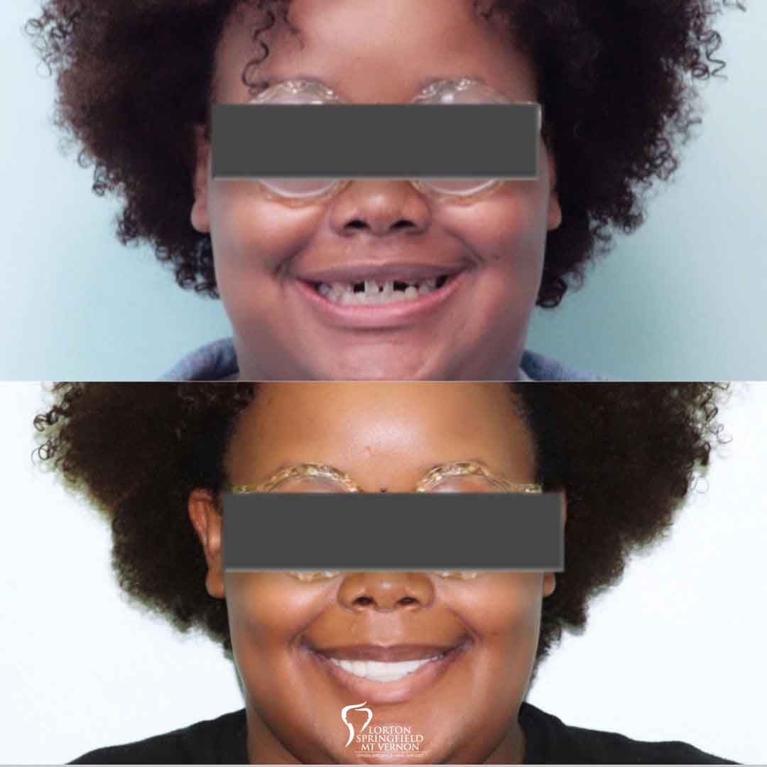 full-smile-makeover-dental-implants-before-after-full-face