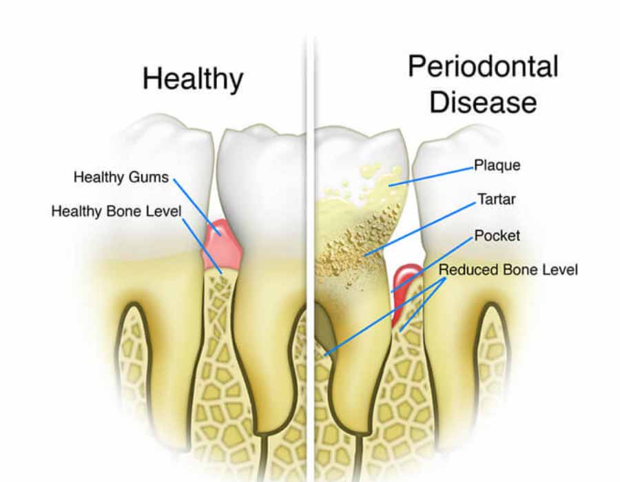 healthy-gums-compared-to-periodontal-disease