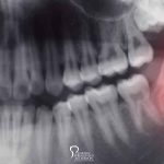 jawbone-loss-and-deterioration-featured