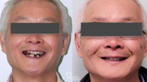 lower-teeth-replaced-implants-before-after-full-face-featured