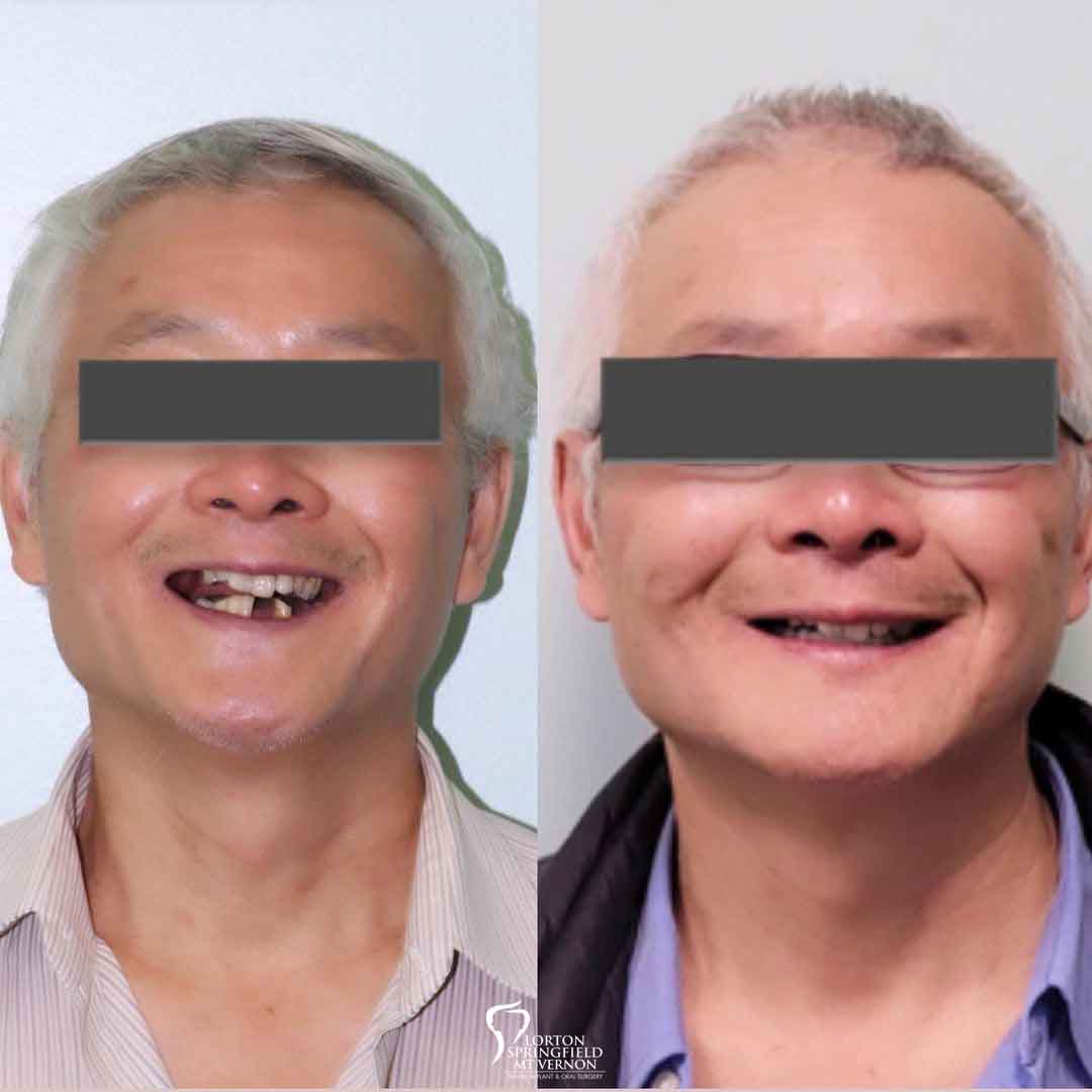 lower-teeth-replaced-implants-before-after-full-face