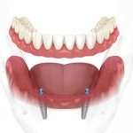 model-of-snap-in-denture-with-2-dental-implants