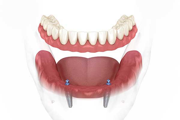model-of-snap-in-denture-with-2-dental-implants