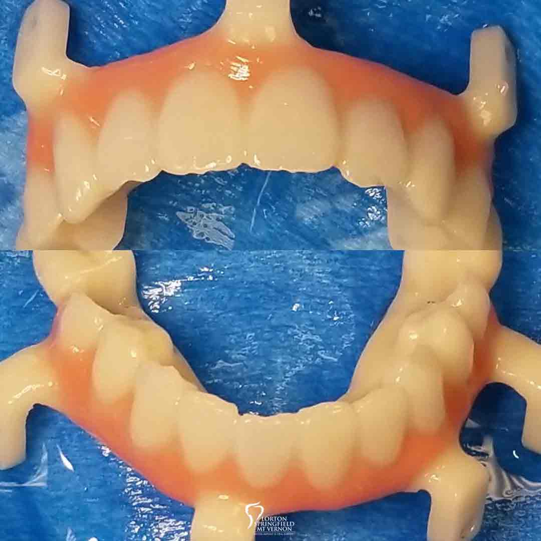 non-removable-hybrid-dentures
