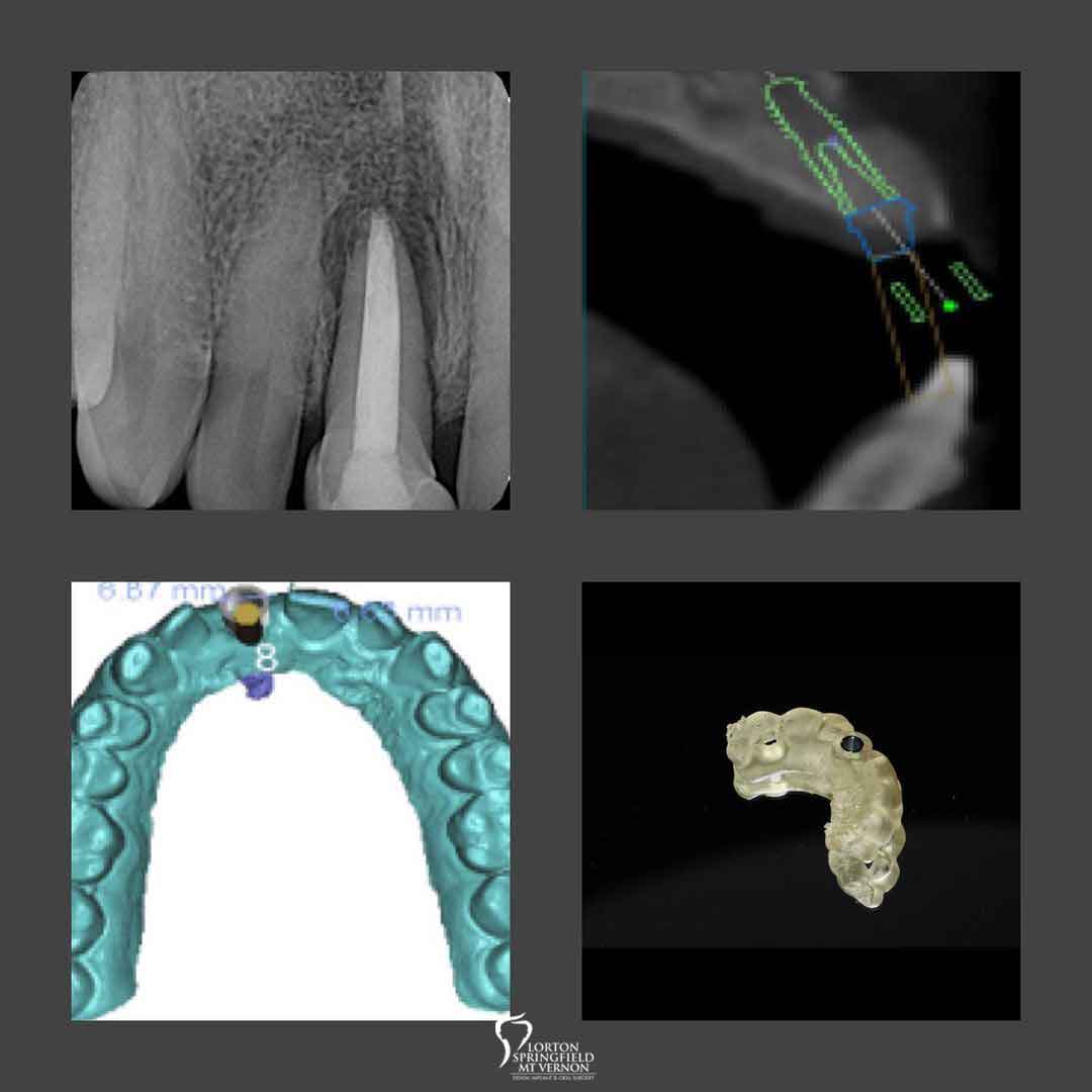 non-restorable-tooth-replaced-dental-implant-X-Ray
