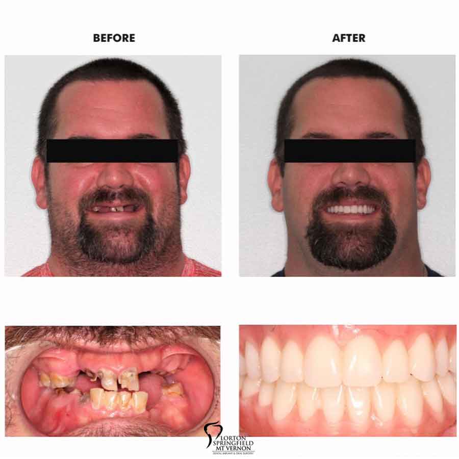 restored-smile-hybrid-denture-before-after