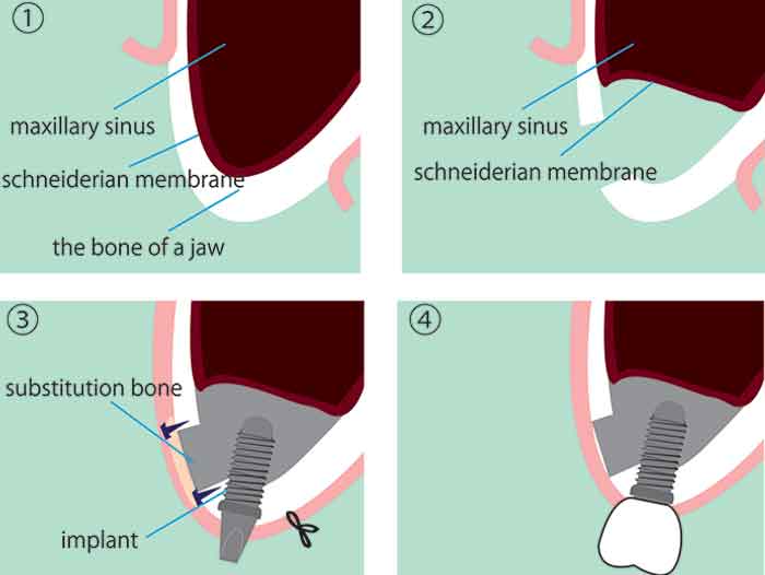 sinus-augmentation-example