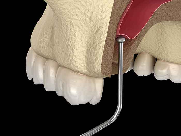 Oral Surgery Procedures | Dental Implant & Oral Surgery