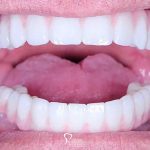 teeth-closeup-after-implant-supported-dentures-featured