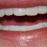 teeth-closeup-before-after-complete-rehabilitation-dental-implants-featured
