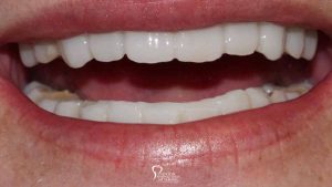teeth-closeup-before-after-complete-rehabilitation-dental-implants-featured