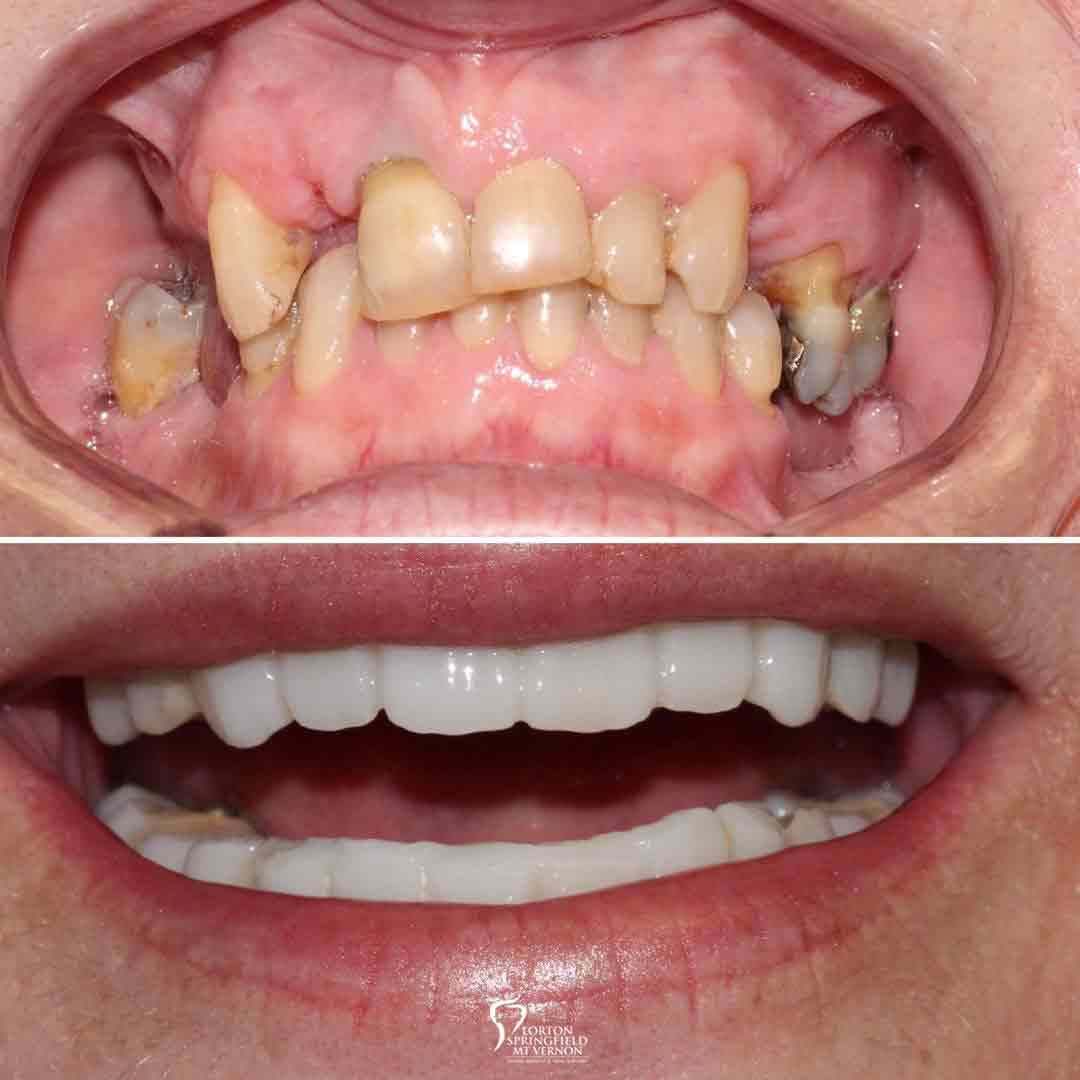 teeth-closeup-before-after-complete-rehabilitation-dental-implants