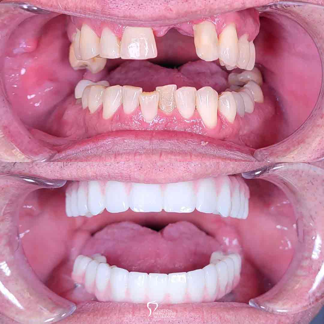 teeth-closeup-before-after-implant-supported-dentures