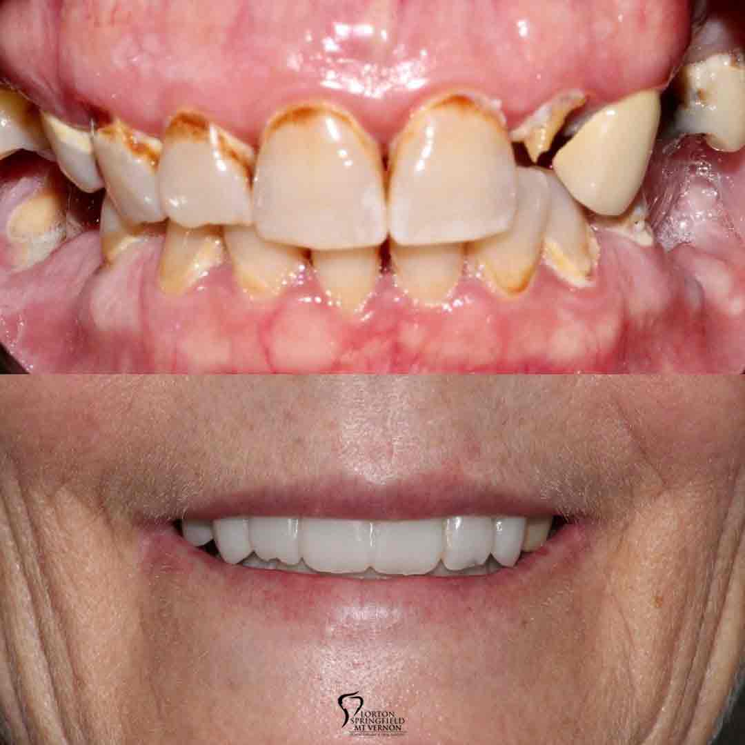 teeth-closeup-before-after-non-removable-hybrid-dentures-dental-implant