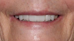 teeth-closeup-before-after-non-removable-hybrid-dentures-dental-implants-featured