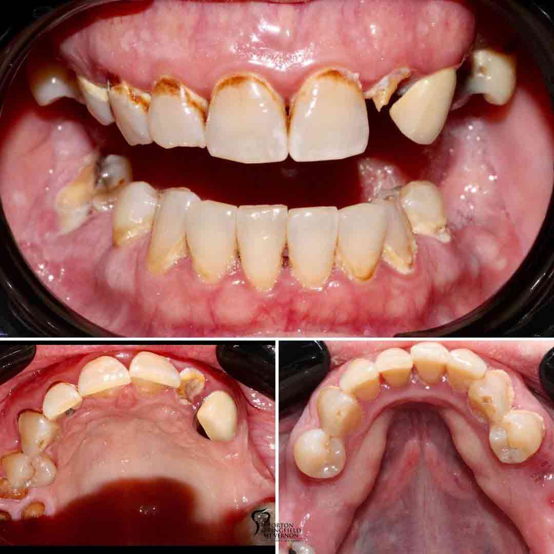 teeth-closeup-before-after-non-removable-hybrid-dentures-dental-implants