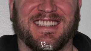 upper-and-lower-hybrid-dentures-feature2