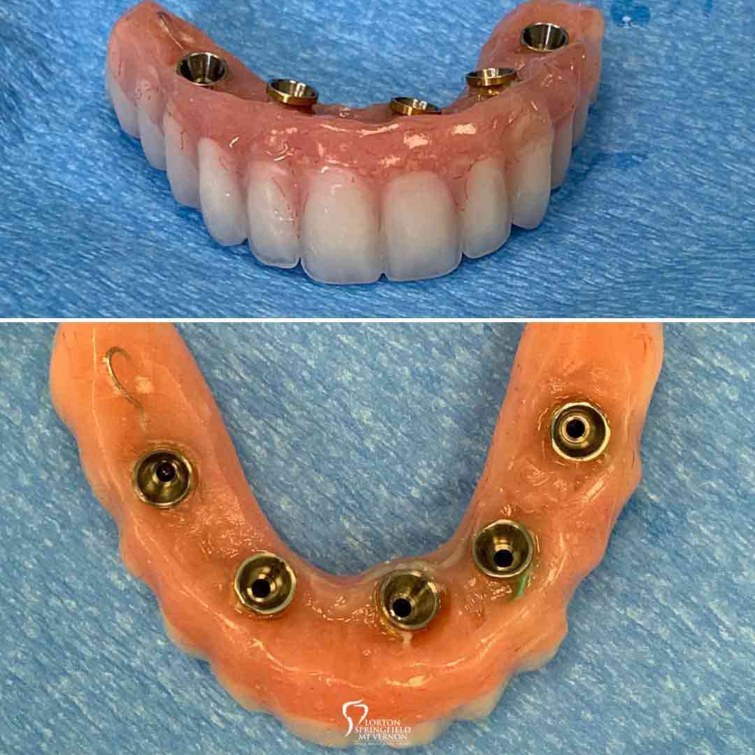 upper-hybrid-conversion-dental-implants