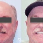 Dental-implant-supported-hybrid-denture-full-face-featured