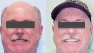 Dental-implant-supported-hybrid-denture-full-face-featured