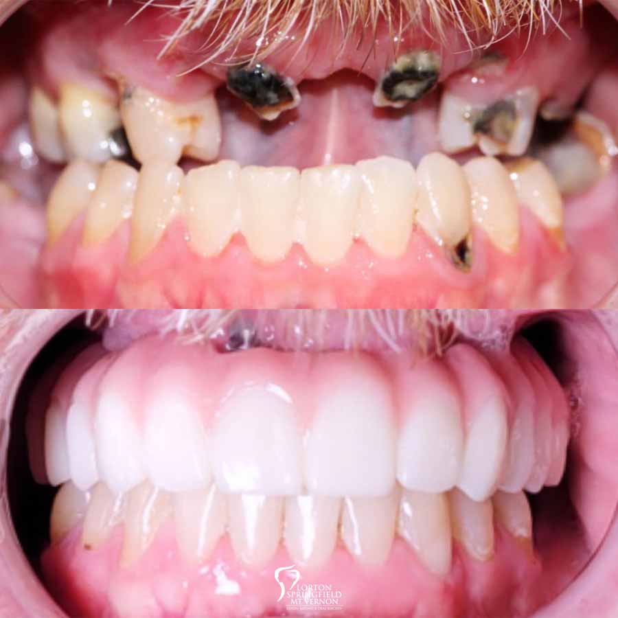 Dental-implant-supported-hybrid-denture-teeth-closeup