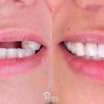 implant-supported-bridge-front-teeth-featured