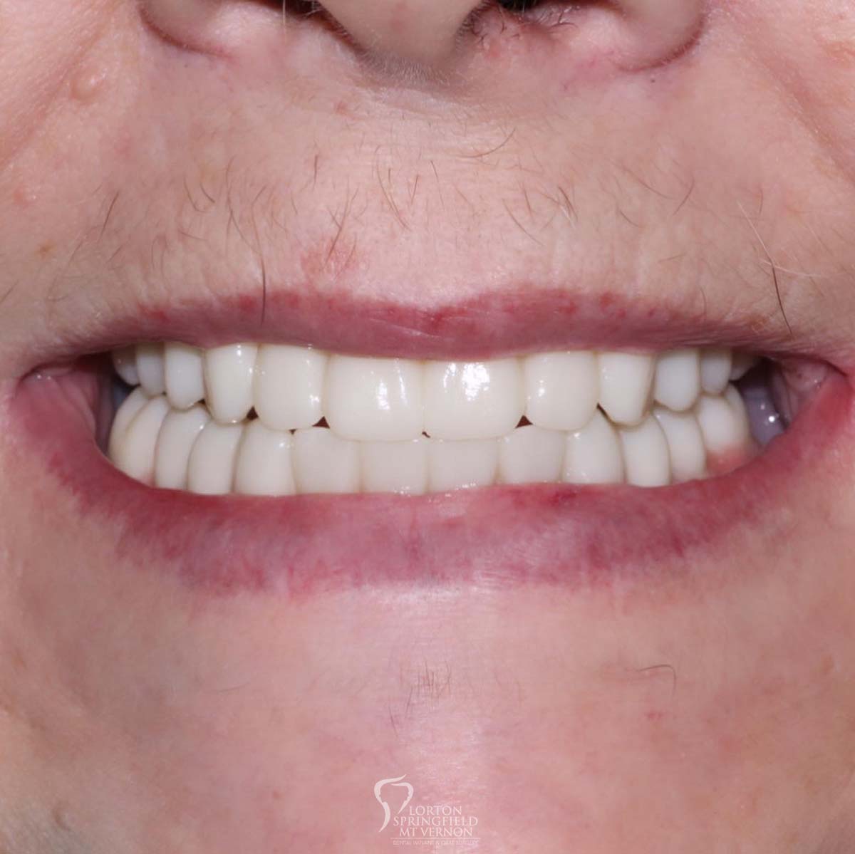 double-arch-hybrid-implant-supported-dentures-4