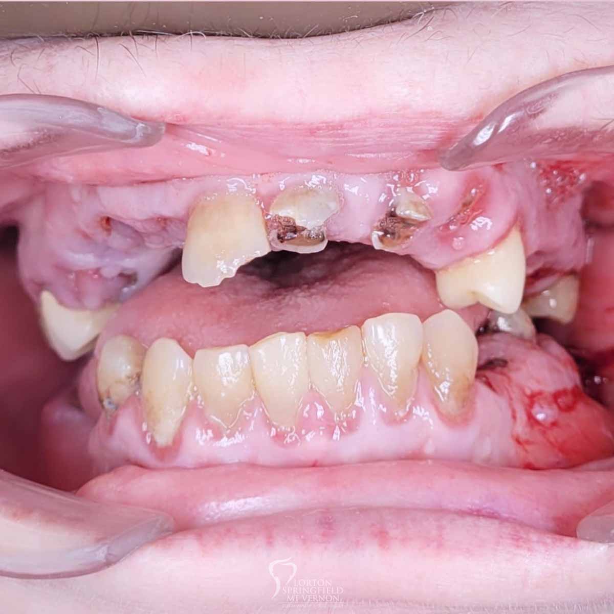 double-arch-hybrid-implant-supported-dentures-5