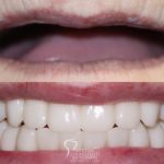 double-arch-hybrid-implant-supported-dentures-featured