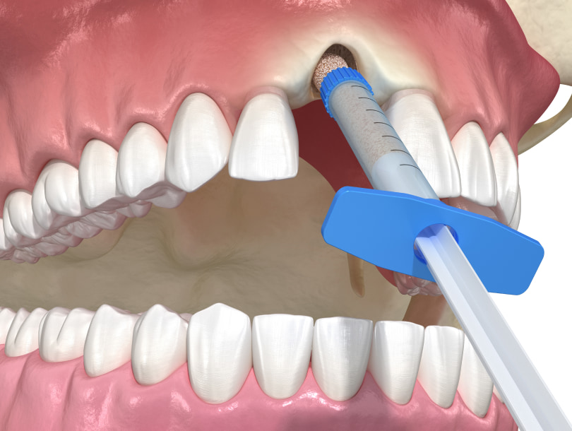 Importance of bone grafting for dental implants at Lorton & Springfield Oral Surgery