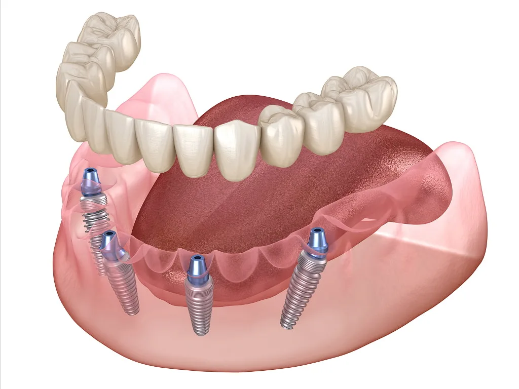 Full-Arch Restoration