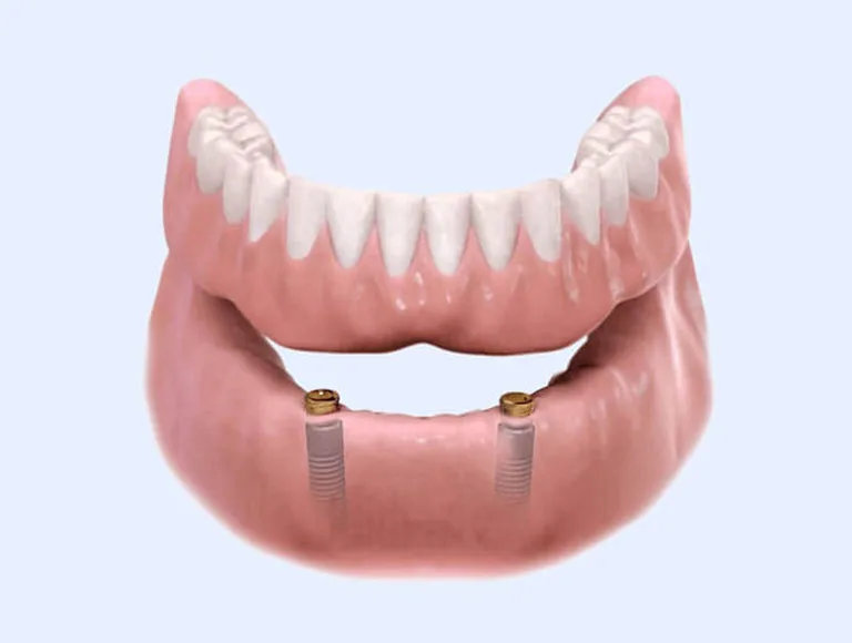 Fixed vs. Removable Solutions